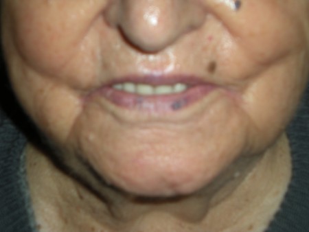 ΟΛΙΚΗ ΟΔΟΝΤΟΣΤΟΙΧΙΑ ΑΝΩ ΚΑΙ ΚΑΤΩ ΓΝΑΘΟΥ